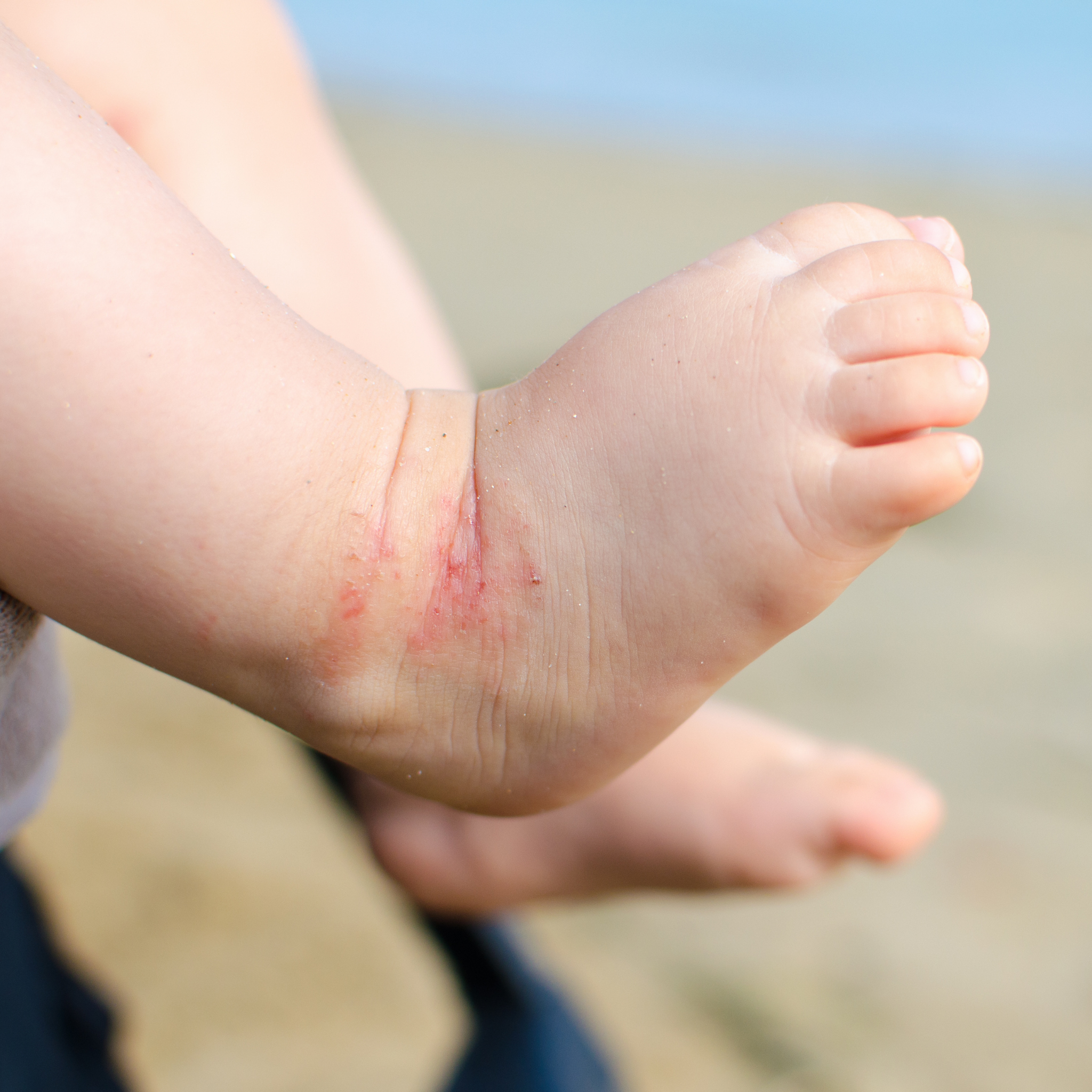Eczema rash on a baby ankle
